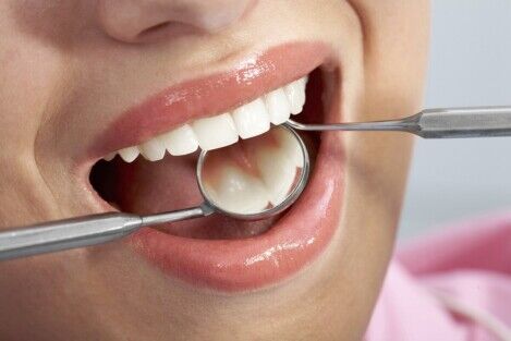 Pulizia dentale a Corcolle