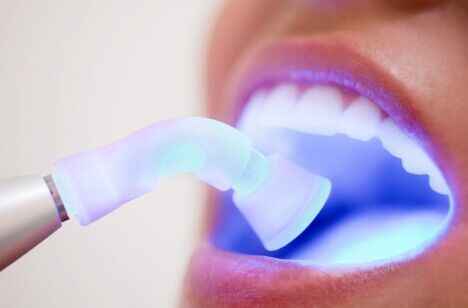 Sbiancamento denti a corcolle
